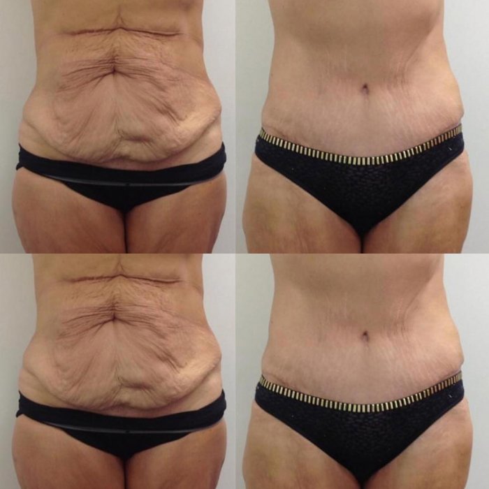 Пластическая хирургия тела