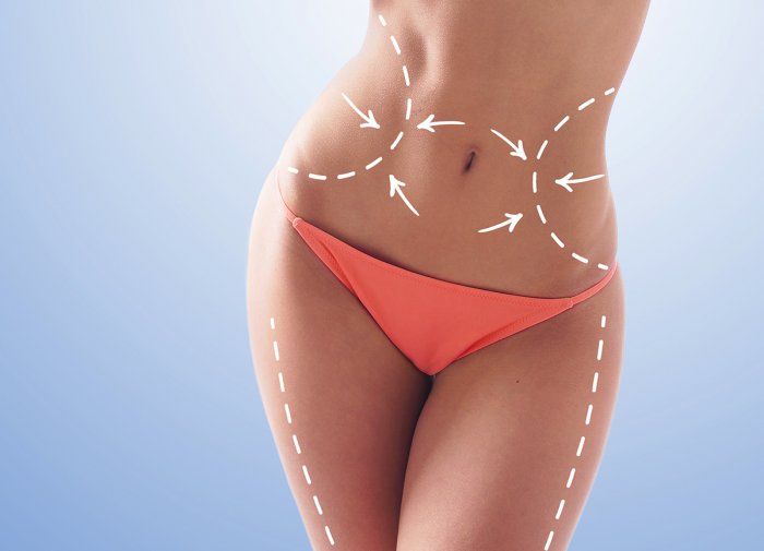 Пластика живота абдоминопластика