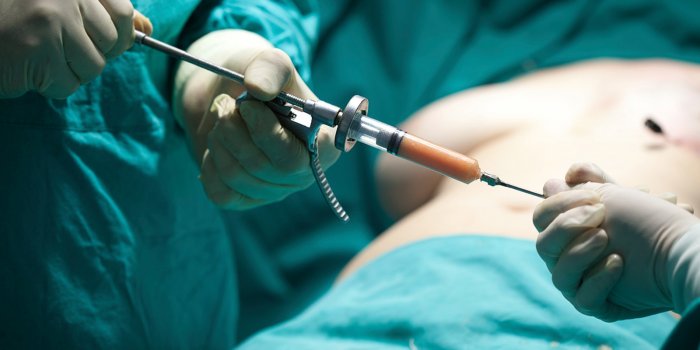 Пластическая операция тела