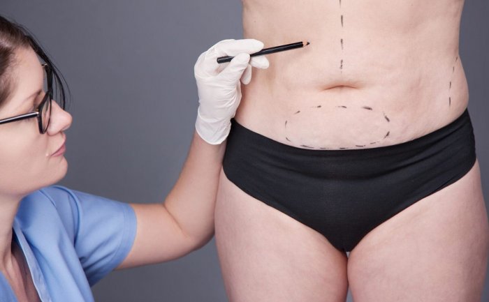 Абдоминопластика растяжки