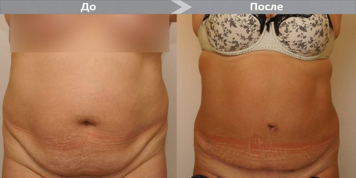 Хирургическая липосакция