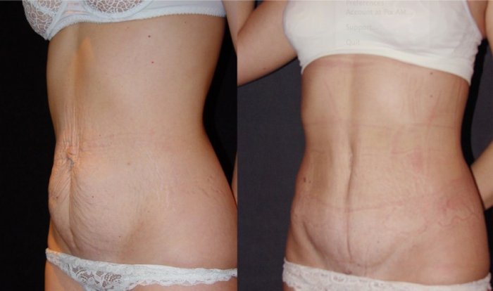 Тумесцентная липосакция