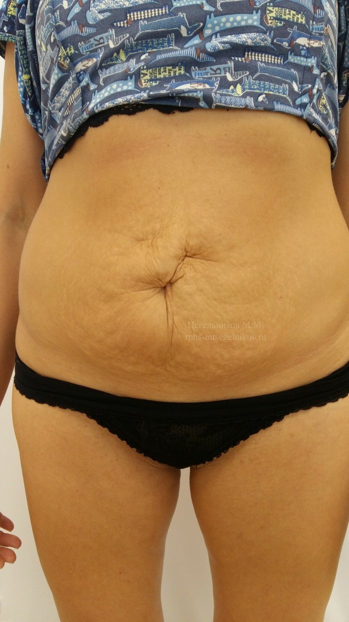 Пресс пластическая хирургия