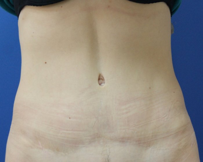 Липосакция Самир Седышев