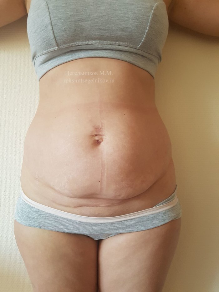 Миниабдоминопластика с диастазом