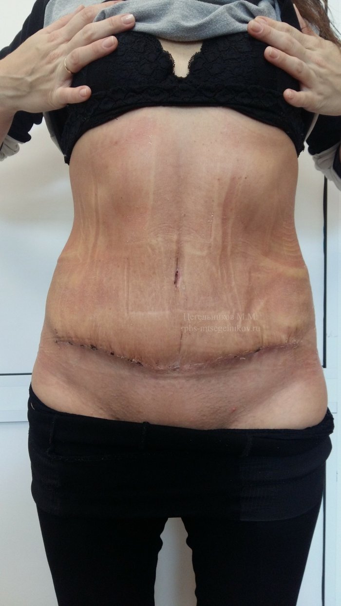 Абдоминопластика пластика