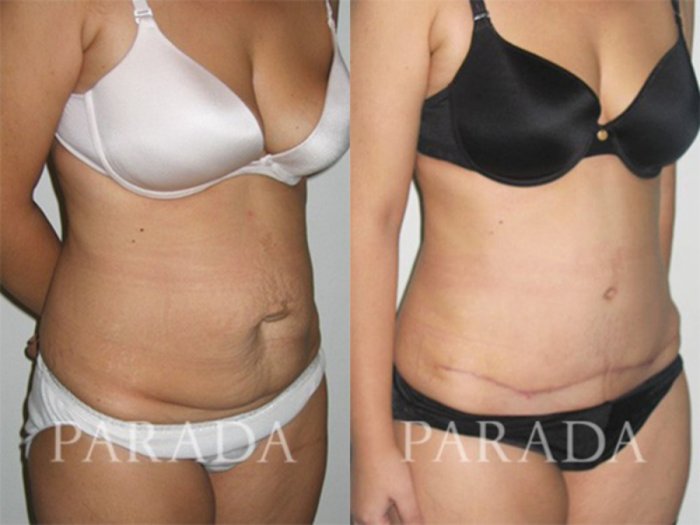 Пластика живота абдоминопластика