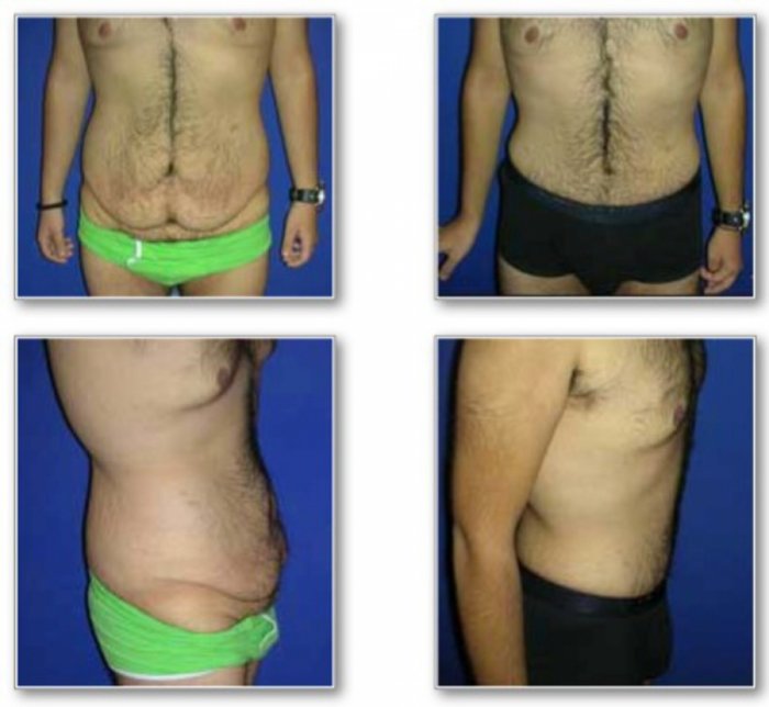 Пластическая хирургия липоскульптура