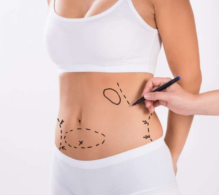 Сидоренков абдоминопластика