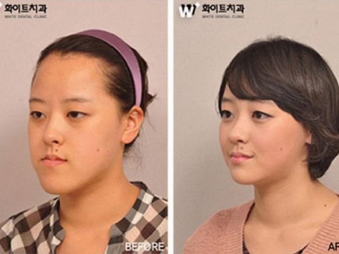 Корейские пластические операции до и после
