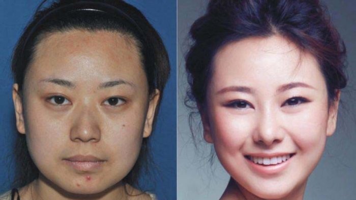 Пластическая хирургия в Корее до и после