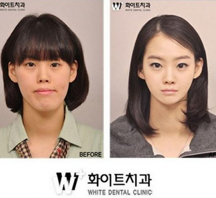 Пластические операции в Корее до и после