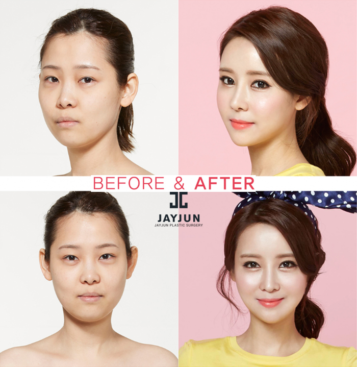 Корейские пластические операции