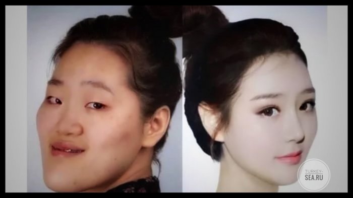 Корейцы без операций