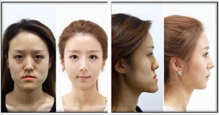 Пластика челюсти и подбородка Корея