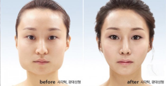 Антивозрастная пластика в Корее