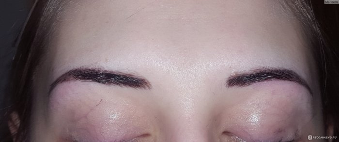 Удаление микроблейдинга в Орле